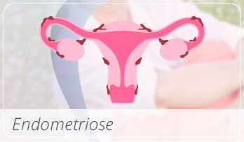 Chamada Endometriose